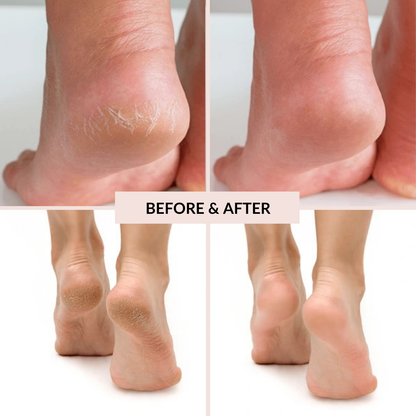 Electric Callus Remover